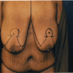 Breast Lifts 10