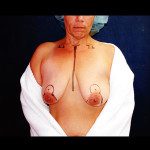 Breast Lifts 2
