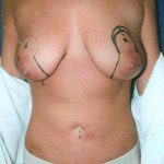 Breast Lifts 8