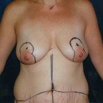 Breast Lifts 7