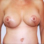 Breast Lifts