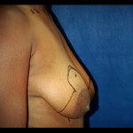 Breast Lifts 6