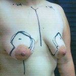 Breast Lifts 5