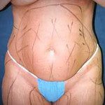 Liposuction 19