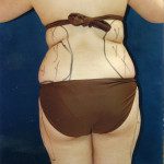 Liposuction 6