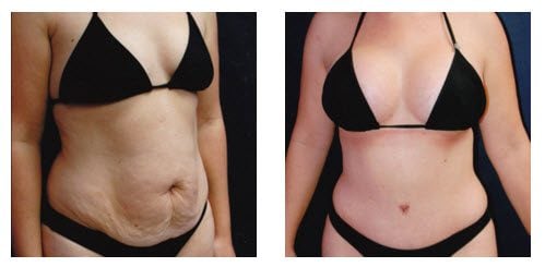 Beautiful Breasts and Waist After Mommy Makeover Procedure - Plastic  Surgeon