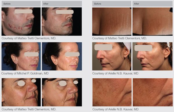 Lumenis ResurFX Laser Skin Resurfacing Treatment before and after photos