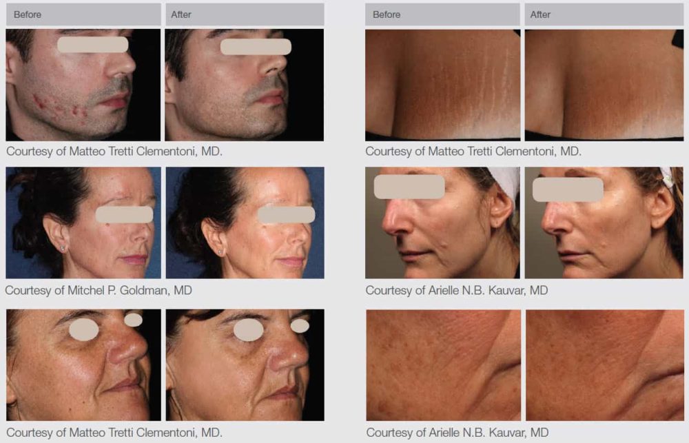 Laser Skin Resurfacing as a Non-Surgical Facelift Alternative